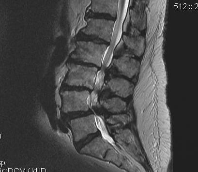 Lumbar MRI Stenosis Sagittal T2